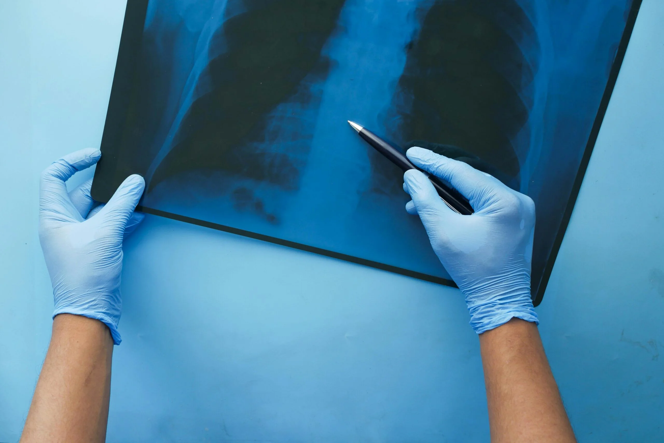 A doctor in blue gloves examines a chest x-ray with a pen, focusing on medical diagnosis.